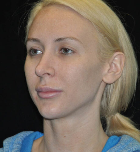 Revision Rhinoplasty case #15096