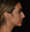 Rhinoplasty case #15326