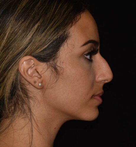 Rhinoplasty case #15326