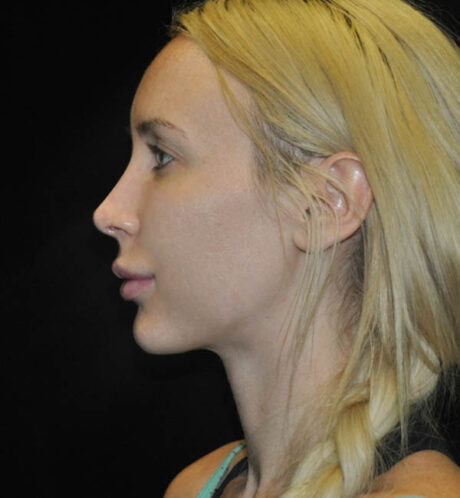 Revision Rhinoplasty case #15096