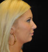 Rhinoplasty case #15321