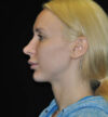 Revision Rhinoplasty case #15096