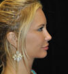 Rhinoplasty case #15321
