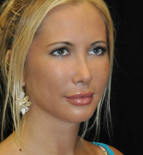 Rhinoplasty case #15321