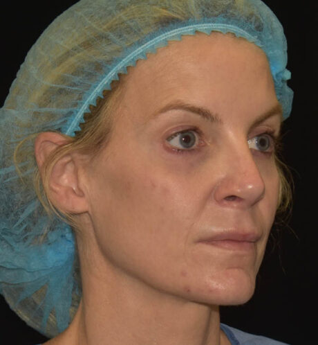 Revision Rhinoplasty case #15101