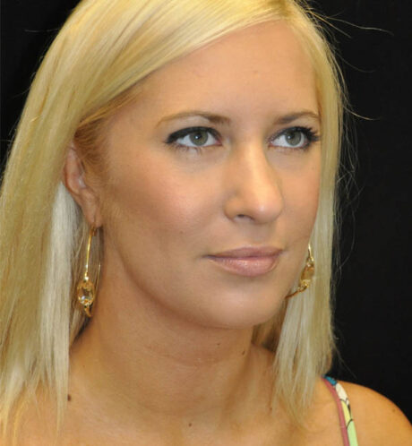 Rhinoplasty case #15321
