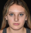 Rhinoplasty case #15314