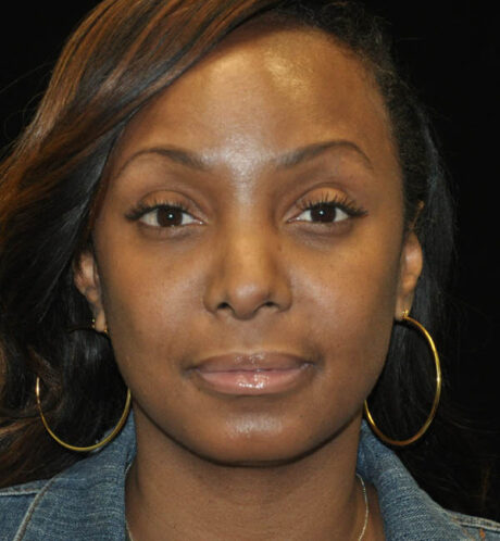 Revision Rhinoplasty case #15104