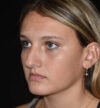 Rhinoplasty case #15314