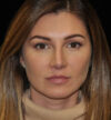 Revision Rhinoplasty case #15110