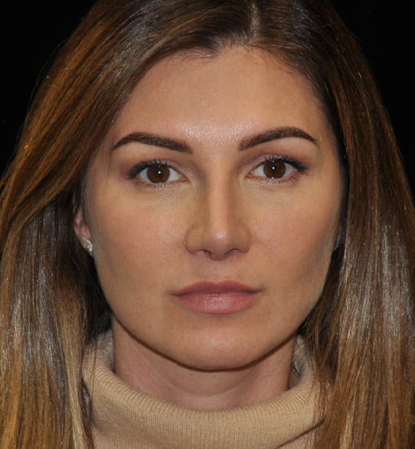 Revision Rhinoplasty case #15110