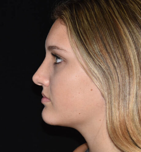 Rhinoplasty case #15314