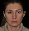 Revision Rhinoplasty case #15110