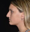 Rhinoplasty case #15314