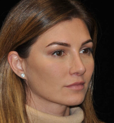 Revision Rhinoplasty case #15110