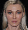 Rhinoplasty case #15309