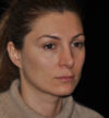 Revision Rhinoplasty case #15110