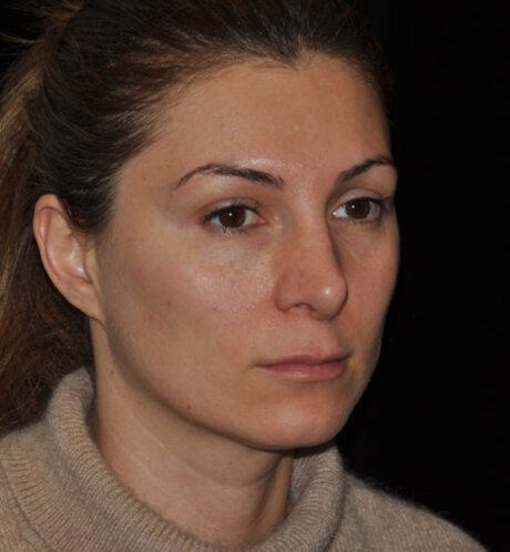 Revision Rhinoplasty case #15110