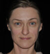 Rhinoplasty case #15309