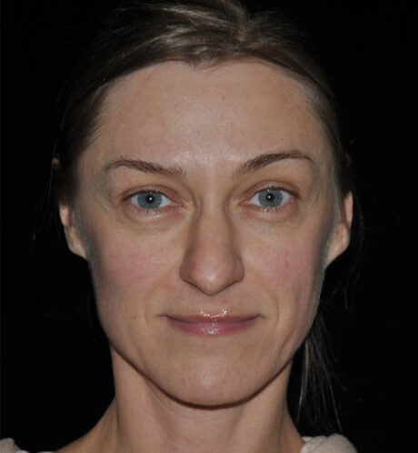 Rhinoplasty case #15309