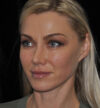 Rhinoplasty case #15309