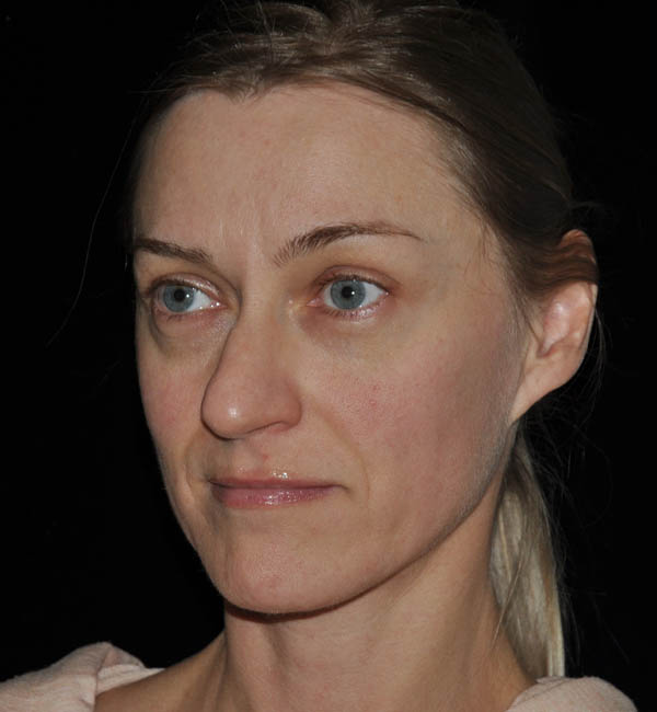 Rhinoplasty case #15309