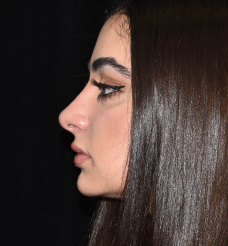 Rhinoplasty case #15304