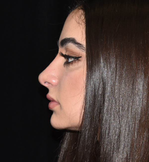 Rhinoplasty case #15304