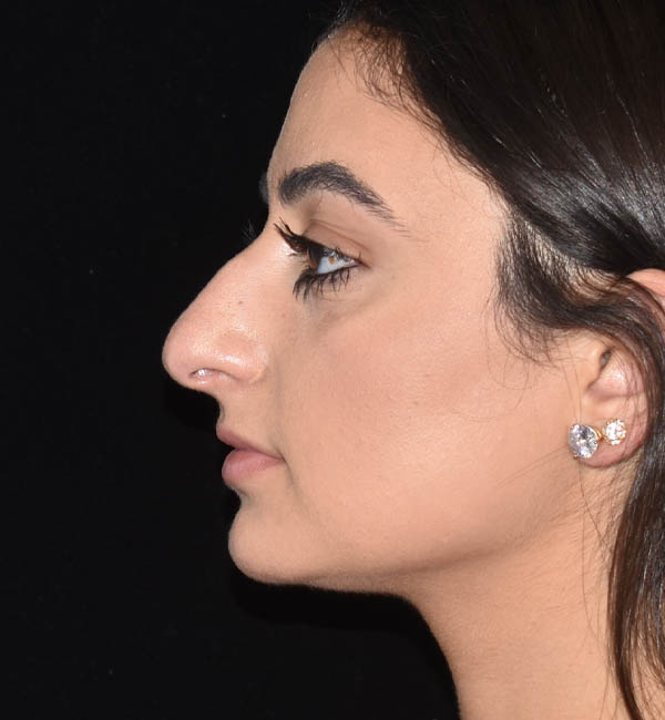 Rhinoplasty case #15304