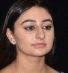 Rhinoplasty case #15304