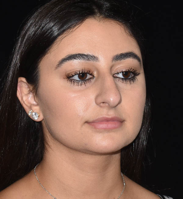 Rhinoplasty case #15304