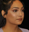 Rhinoplasty case #15272