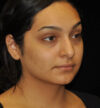 Rhinoplasty case #15272