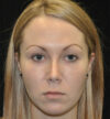 Rhinoplasty case #15265