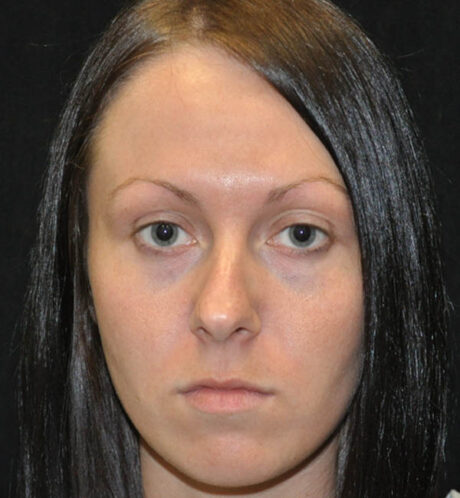Rhinoplasty case #15265