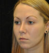 Rhinoplasty case #15265