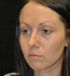 Rhinoplasty case #15265