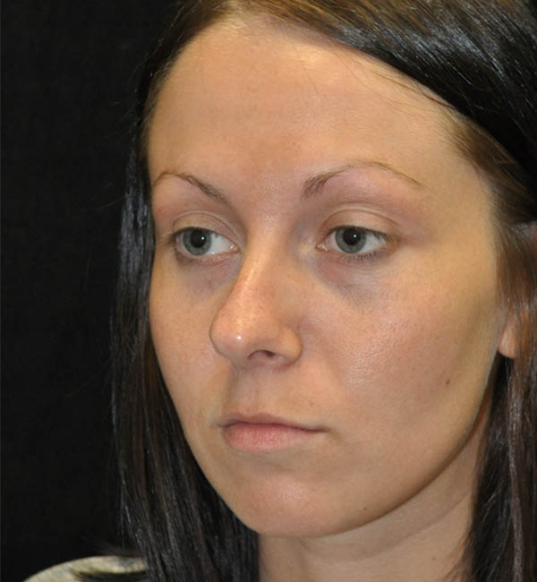 Rhinoplasty case #15265