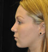 Rhinoplasty case #15265