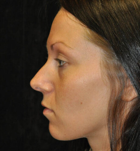 Rhinoplasty case #15265