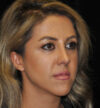 Rhinoplasty case #15257
