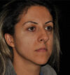 Rhinoplasty case #15257