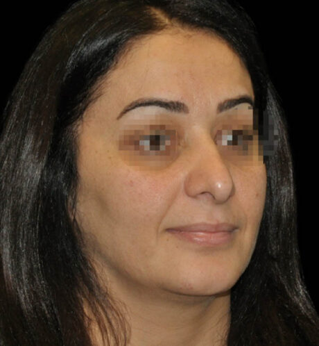Rhinoplasty case #15254