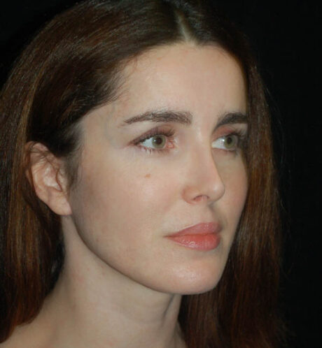 Rhinoplasty case #15249