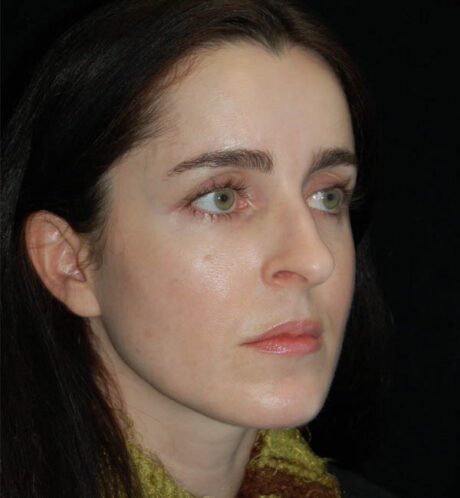 Rhinoplasty case #15249