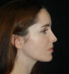 Rhinoplasty case #15249