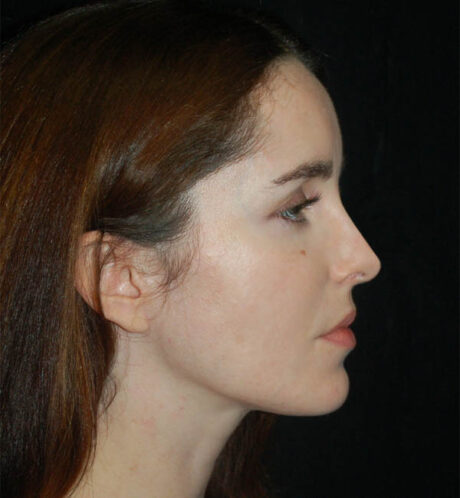 Rhinoplasty case #15249