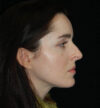 Rhinoplasty case #15249
