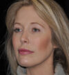 Rhinoplasty case #15242