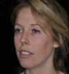 Rhinoplasty case #15242